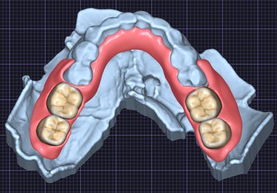 Partial Denture