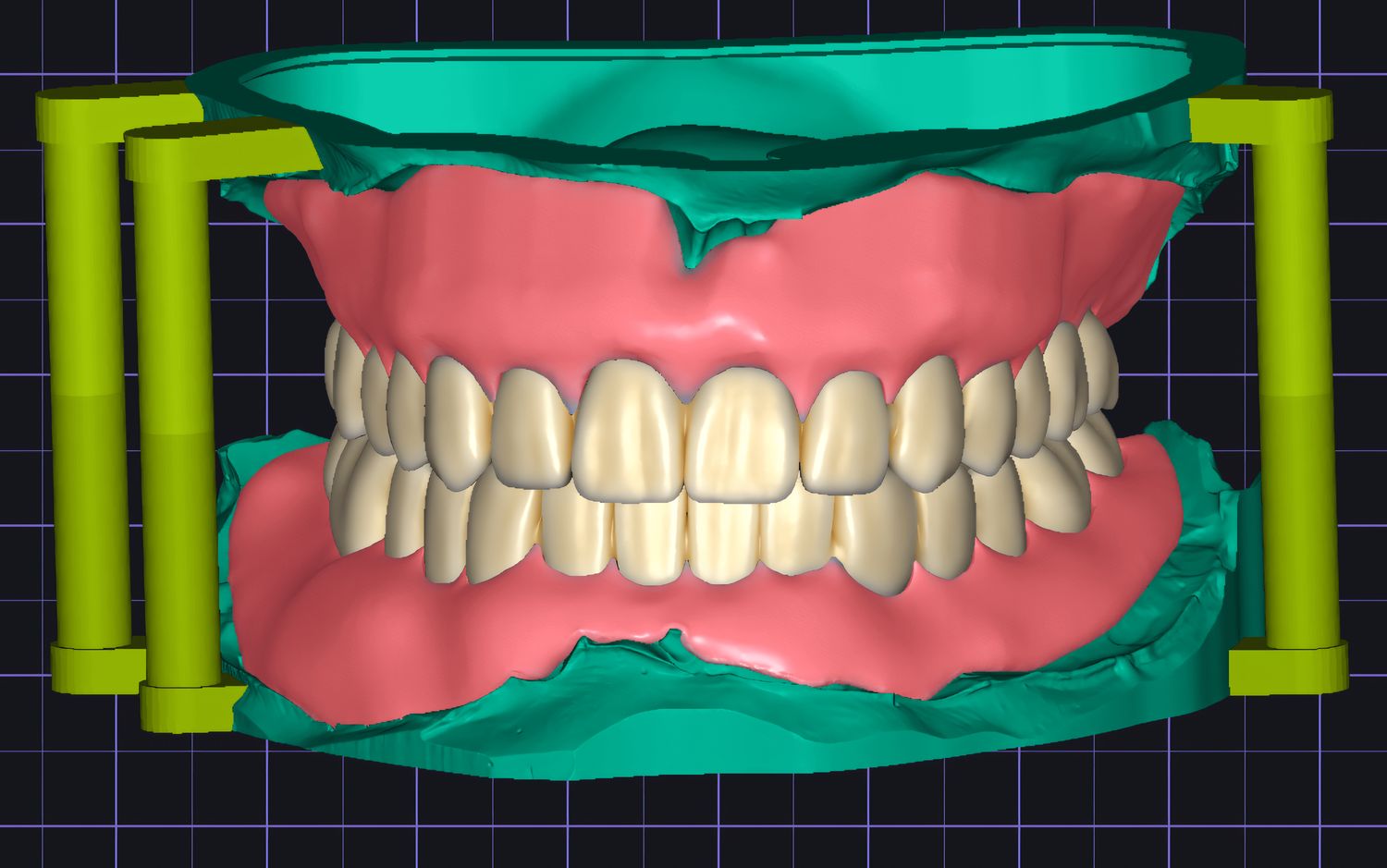 Full Denture