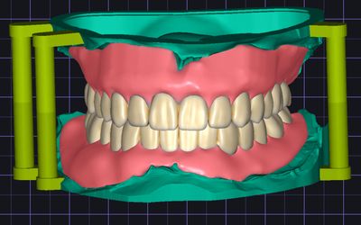 Full Denture