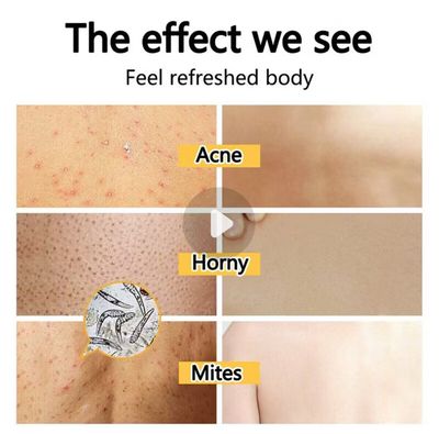 2bottle $10.00 - Shower Body Wash Mite Removal Acne Lasting Fragrance 260ml Unisex Body Wash Mite Removal Acne Lasting Fragrance, Cleaning Hydrating Whitening Remove Mites Shrink Pores Control Oil