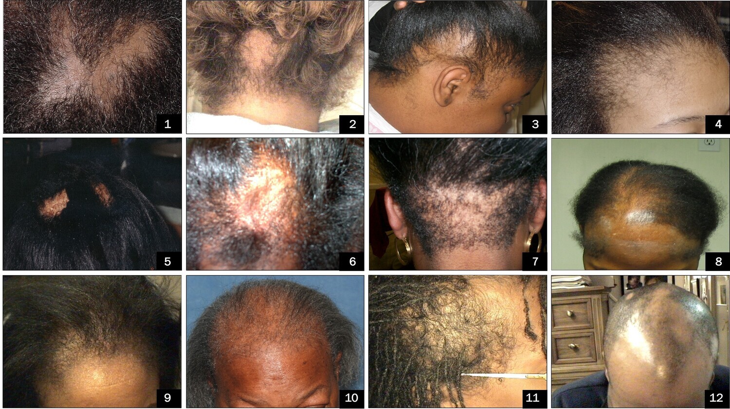 Class #1 - How to Properly Identify the Most Common Hair and Scalp Disorders - Monday, February 19th, 2024 12PM-2PM EST