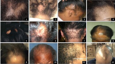 Class #1 - How to Properly Identify the Most Common Hair and Scalp Disorders - Monday, February 19th, 2024 12PM-2PM EST