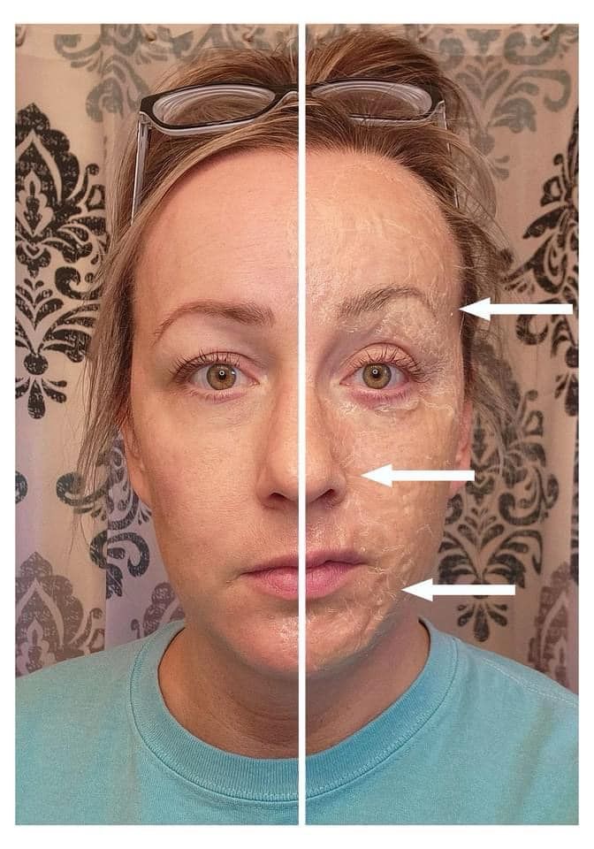 Face Lift