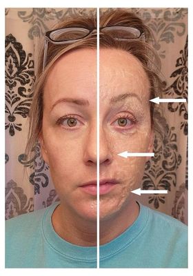 Face Lift