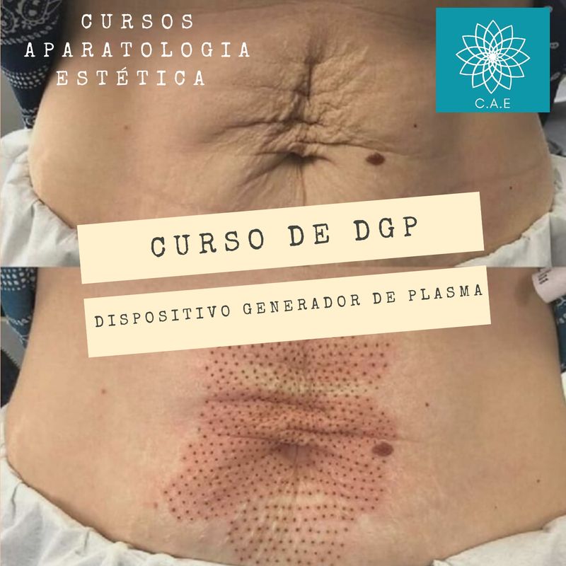 Curso Online Dispositivos Generadores de plasma + CERTIFICACIÓN