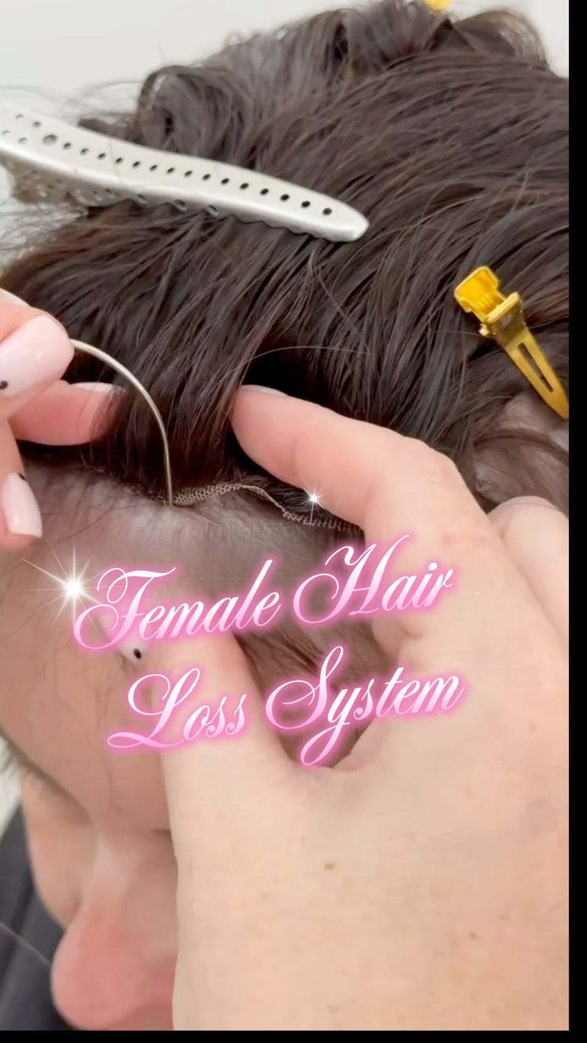 FEMALE HAIR LOSS SYSTEM