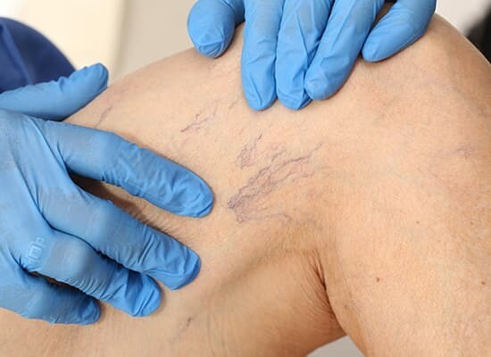 30 min Spider of Facial Vein Treatment - now just $249