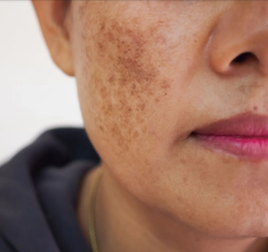 Sun Spot Treatment - now just $199.00