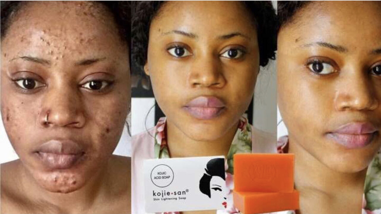 KOJIC ACID SOAP