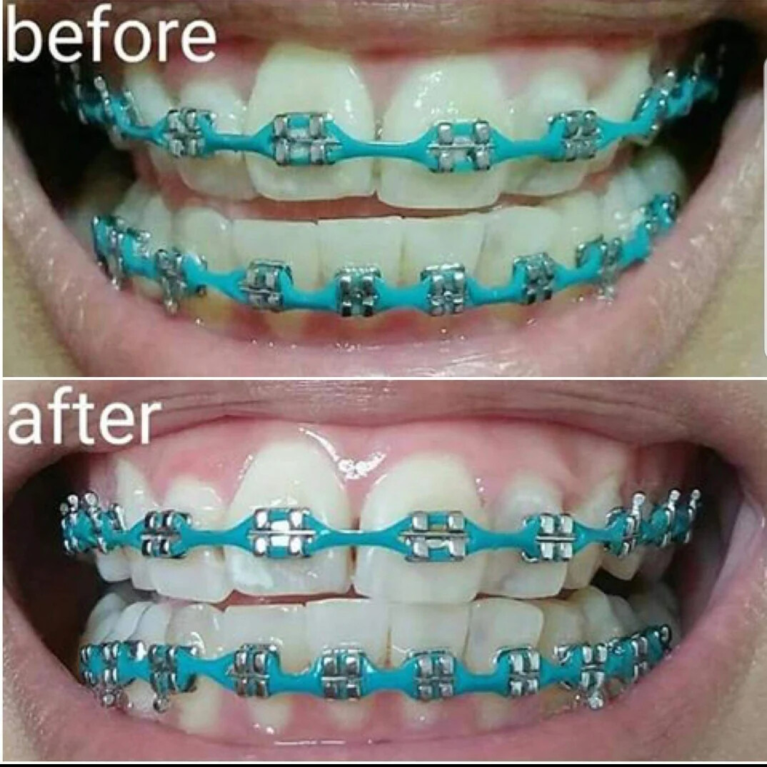 Whitening Toothpaste