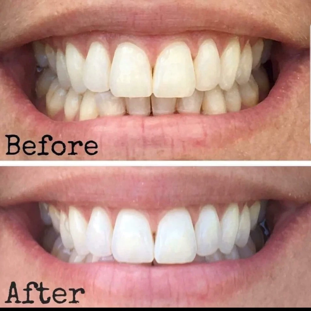 Whitening Toothpaste