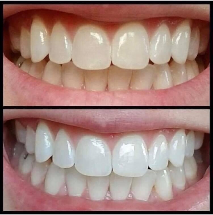 Whitening Toothpaste