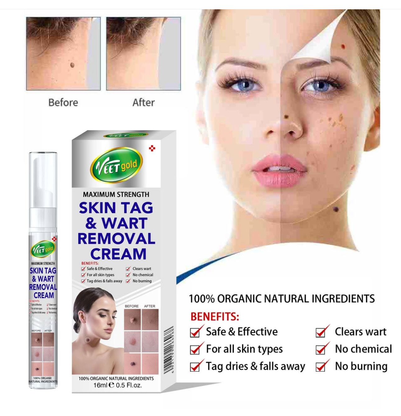 SKIN TAG &amp;WART REMOVER