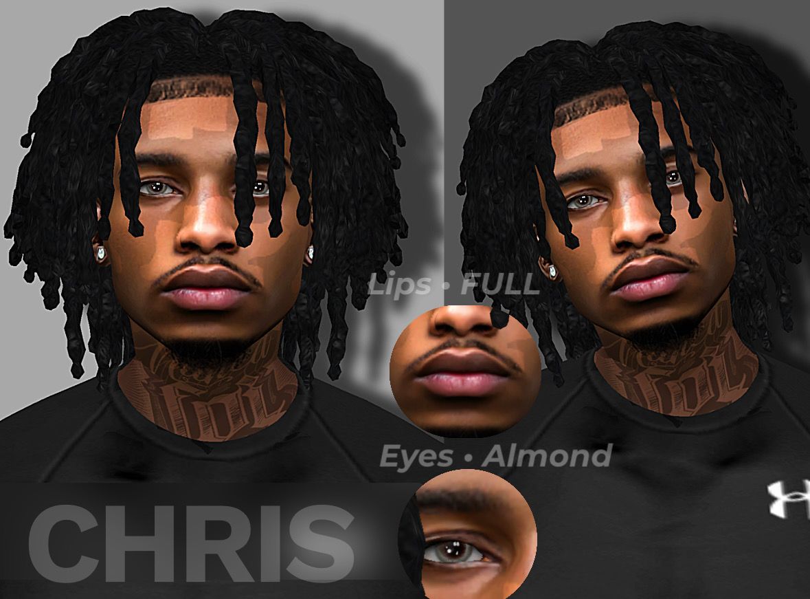 CHRIS ( VITILIGO)