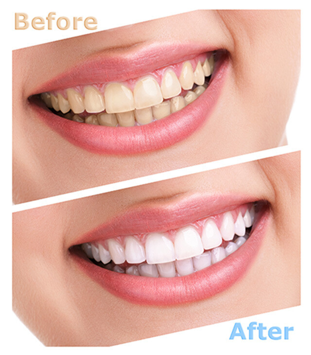 Aligner  Seaters Chewies Invisalign