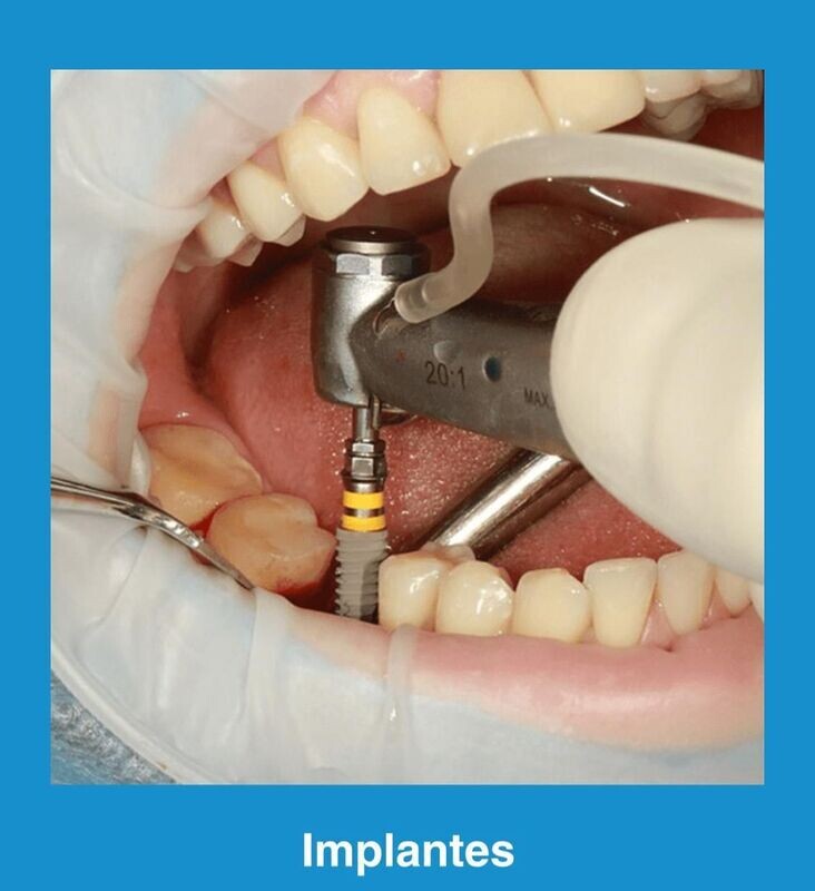 Implantes