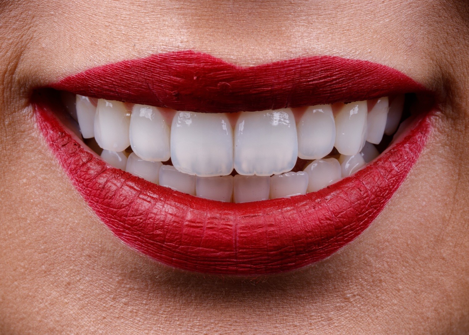 Resin Smile Design (20 teeth)