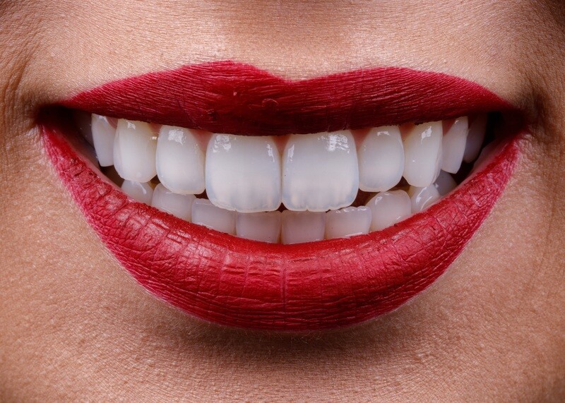 Resin Smile Design  (20 teeth)