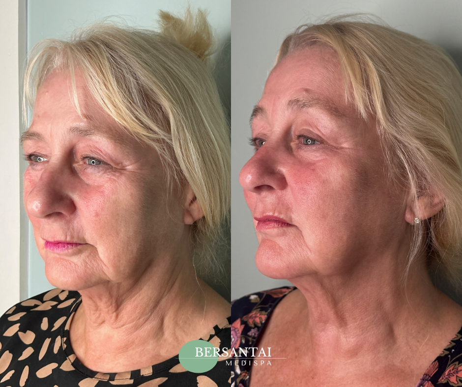 FIBRO Full Face & Neck