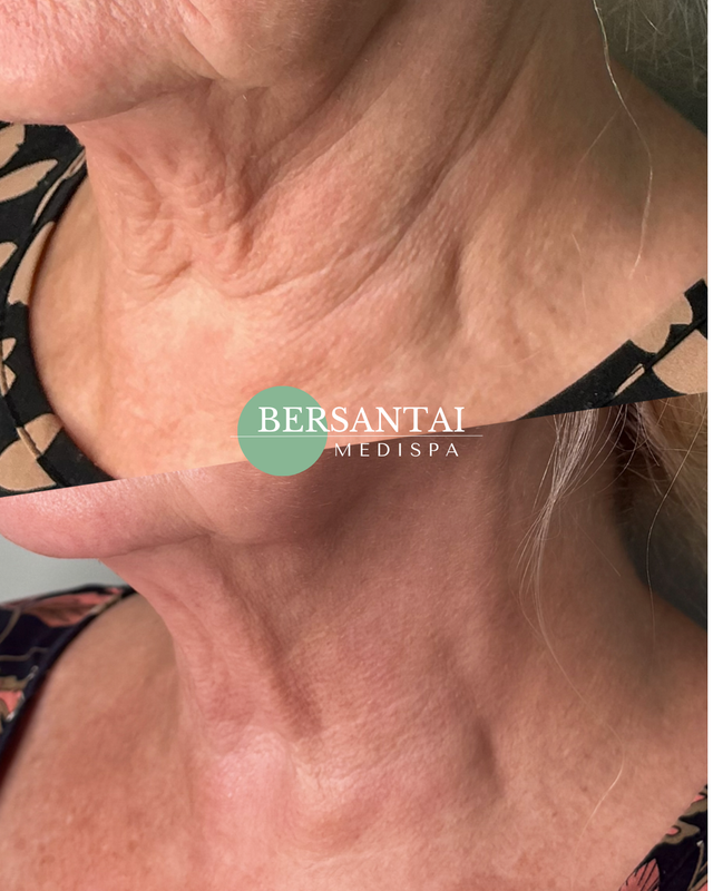 FIBRO Full Neck