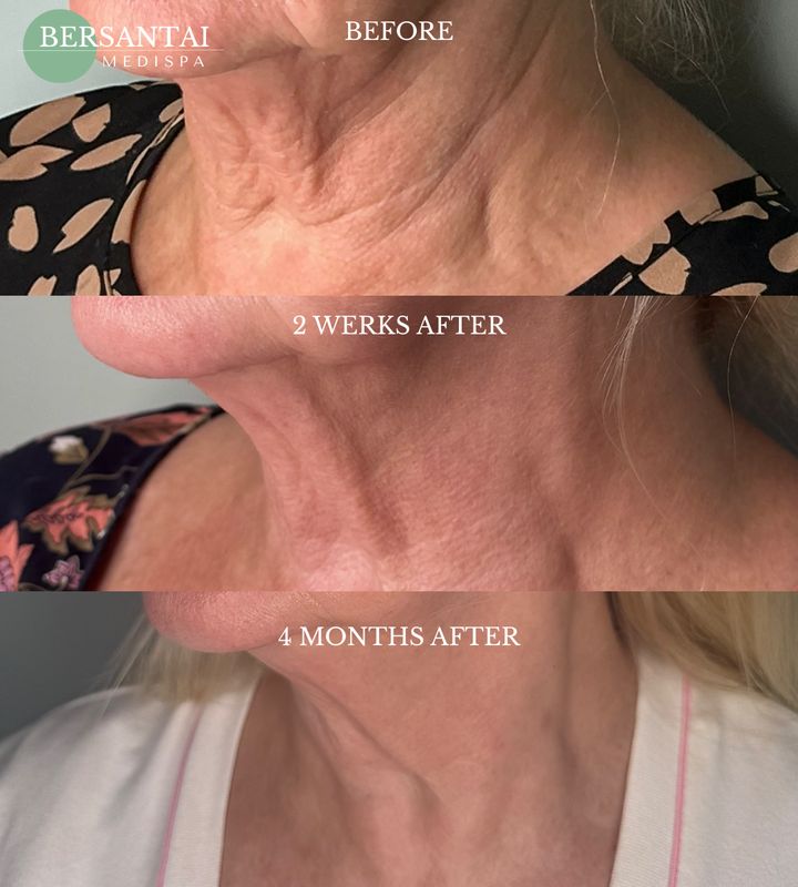 FIBRO & FRAXEL 1K DEAL