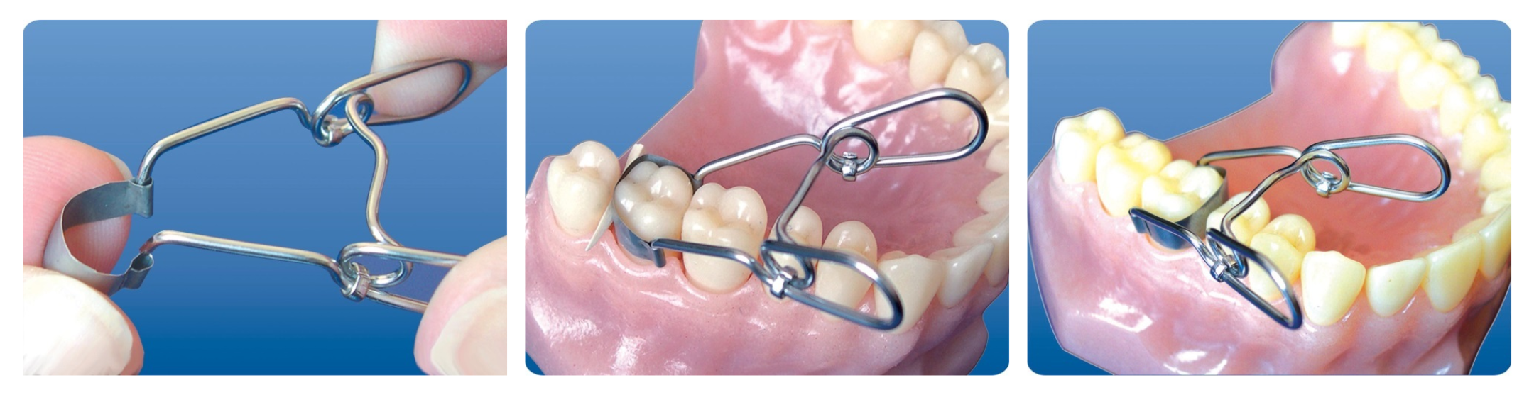 Fixarea matricii cu fixator