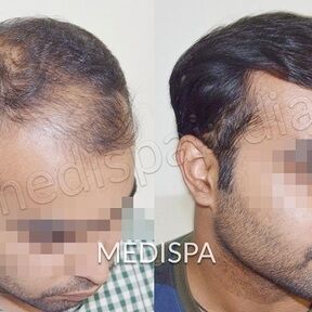 Medispa Hair Transplant Medispa Hair Transplant